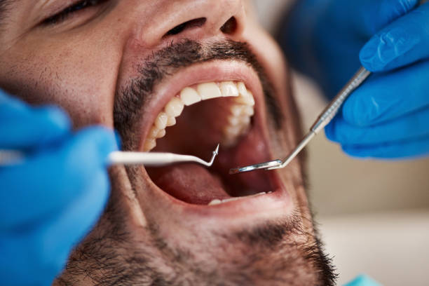 Best Dental Abscess Treatment in Clarksville, TN